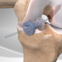 operation ligament croisé chrirurgienorthopedisteparis