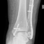 ostéosynthèse_fracture_cheville-256595010